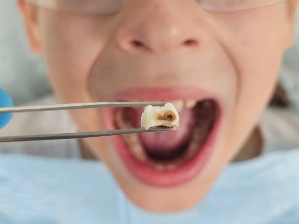 Best Emergency Wisdom Tooth Extraction in Sierra View, PA